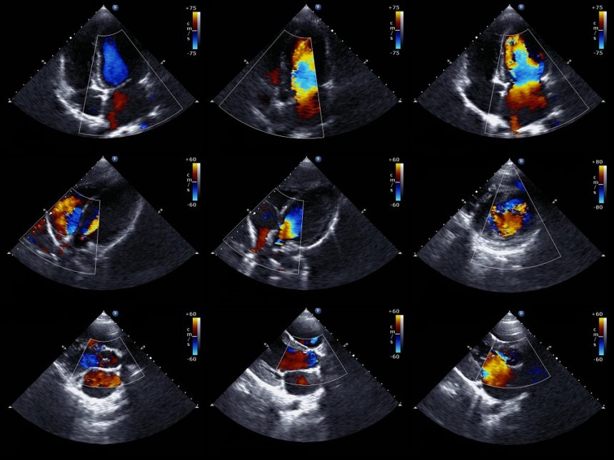 What does an Echocardiogram show?