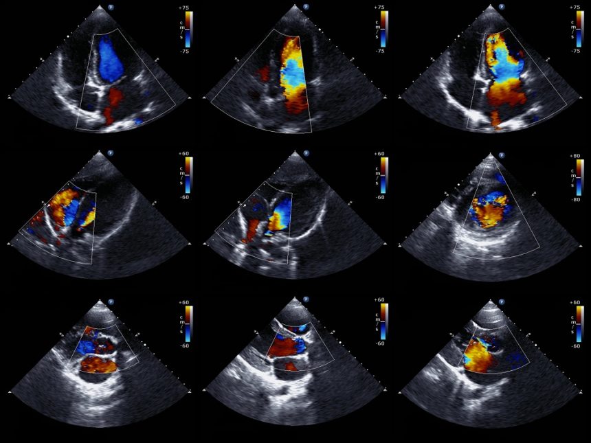 What Does A Lot Of Blue Mean On An Echocardiogram